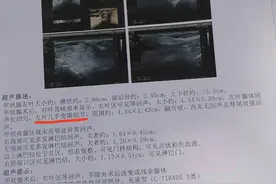 甲状腺全切术5个月后左侧腺叶充满结节：患者质疑漏切，医院建议走司法途径图片