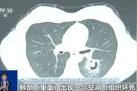 肺部“发霉”！女子高烧三天 竟与清理衣柜有关图片