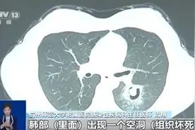 肺部“发霉”！女子高烧三天 竟与清理衣柜有关图片