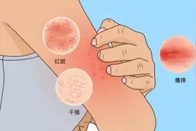 冬季搓澡小心乏脂性皮炎图片