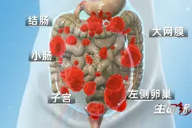 47岁中年女性身患罕见病腹膜假黏液瘤，和《生命缘》一起见证百万分之二的爱图片
