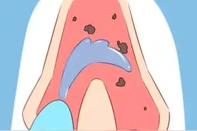 宝宝感冒打喷嚏流鼻涕，可以用鼻腔盐水冲洗吗？图片
