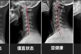 颈椎病的危害你知道吗？医生提醒：出现症状，及早治疗图片