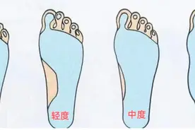 32岁男子反复腰疼，竟是脚惹的祸图片