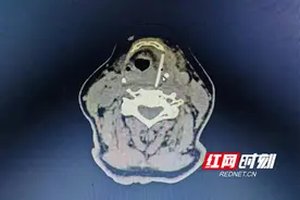 鱼刺卡喉别再喝醋吞米饭！这些方法让鱼刺安全“跑出来”图片