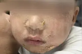 3岁男童吃火锅烫到嘴，三天后全身溃烂！原因查明→图片