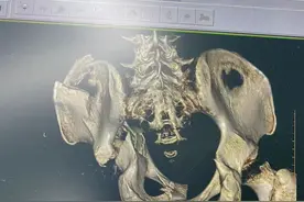 武汉男子高处坠落粉碎性骨折，医生妙手8小时修复图片