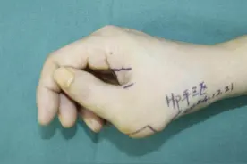 多指畸形手术后为啥仍畸形？专家提醒手术方案很重要图片