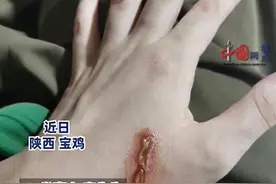 紧急！陕西已发现！男子皮肤多处溃烂，5天未愈....图片