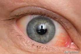 眼睛红肿发痒，可能是过敏性结膜炎！出现症状时不要揉眼，以防加重过敏反应图片