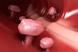 便血，是什么原因引起的?图片