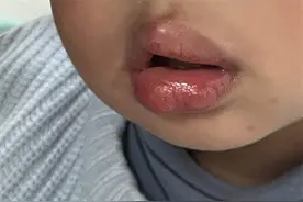 绍兴男童嘴巴肿成“香肠”！原来这些食物要慎吃图片
