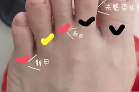 要想解决泛黄增厚的灰指甲，做好这些就够了！图片