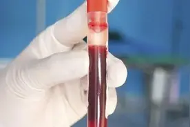 精液竟然带血！男人意外出血可能是这些原因图片