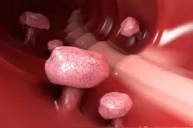 肠道出现息肉时，身体会有4个表现，若你也有，别太大意了图片