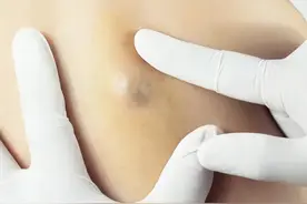 “黑头”越挤越不对劲，原来是皮脂腺囊肿，该怎么办？图片