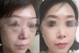 一时冲动跑去北京做了面部悬吊提升，一个月后，烦恼确实很多图片