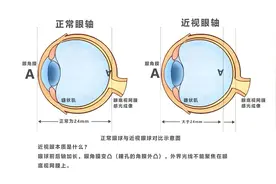 上海眼科院长：为什么高度近视更容易得白内障？能做手术治疗吗？图片
