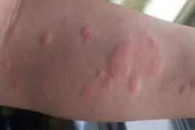 一张名老中医治痒方，远离“秋冬痒”，拒绝皮肤病！图片