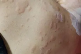 皮肤病的根源在脏腑，再严重的皮肤病也怕这几招，帮你从内除根图片