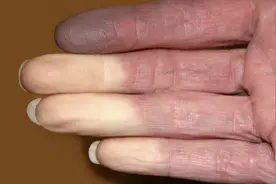 体内有病，手指先知？手指出现这5种异常，可能是疾病或癌症预警图片