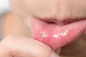极易误诊！福州女子反复口腔溃疡，一查惊了……这种溃疡别当上火治！图片