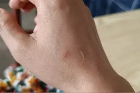 被家里的猫抓伤了，要不要打疫苗？图片