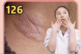 皮肤粗糙起红疹，越抓越痒，越挠越厚，这是#神经性皮炎 ！三步走解决你的神经性皮炎~#医学科普 #皮炎 #皮肤健康 视频封面
