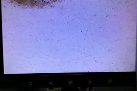第三次前列腺理疗后，一次性排出大量白细胞团！视频封面