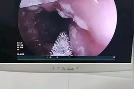 霉菌性食道炎视频封面