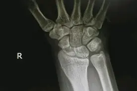 从X线平片上了解腕关节解剖及舟骨骨折视频封面