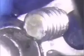 种植牙螺丝意外折断。视频封面