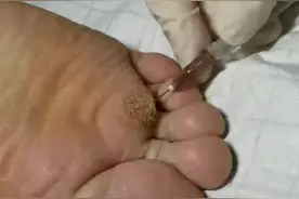 氟尿嘧啶注射治疗跖疣方法