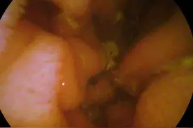 资福医疗大圣胶囊内镜十二指肠影像视频封面