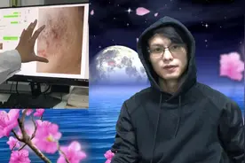 别让痘痘毁你的青春，很多人傻傻分不清闭口、粉刺和痘痘是什么！视频封面