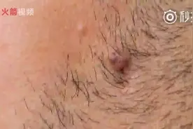 毛发长到肉里会给身体带来多大危害