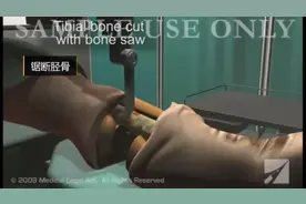 1分钟了解截肢手术全过程视频封面