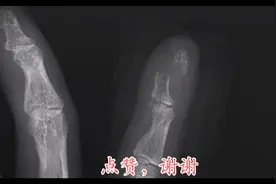 手外伤之小指远节指骨骨折，手组成骨的解剖--全是干货视频封面