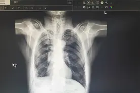 一例让你了解X线平片及CT诊断肺结核有那要点？视频封面