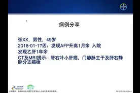 铅甲柔情※许医生 浅谈中晚期肝癌的介入一站式干预策略（4）病例视频封面