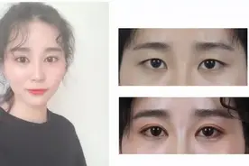 妹子双眼皮+开眼角术后半年对比，真实诠释：一双眼拯救整张脸视频封面