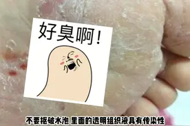 脚底有小水泡，抠破还有渗液流出？这是水泡型的脚气。#健康视频封面