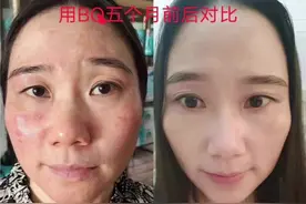 分享，脸上长痘痘有三个原因：很多小姐姐脸上长了痘痘，就算好了视频封面
