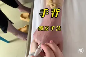 留置针穿刺日常分享……手背，绷皮手法#留置针 #护士视频封面