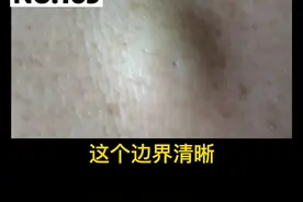 身上出现硬硬的肿物，可以自己用手挤吗？#表皮样囊肿#健康 #科普 视频封面