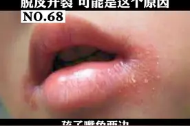 孩子嘴角经常发红干燥、脱皮开裂，可能是这个原因#医学科普 #烂嘴角 #孩子 视频封面