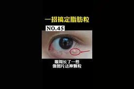 一招搞定脂肪粒#皮肤 #脂肪粒 视频封面