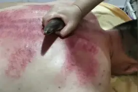 净化血液 帅哥排出来的痧都是黑色的视频封面