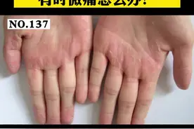  手上脱皮发痒，试试这样子处理。#医学科普 #皮肤 #手脱皮 #指掌角皮症 