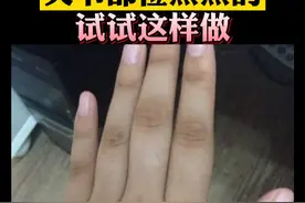 手指关节、胳膊肘黑黑的，影响美观，应该怎么办#科普 #皮肤 视频封面